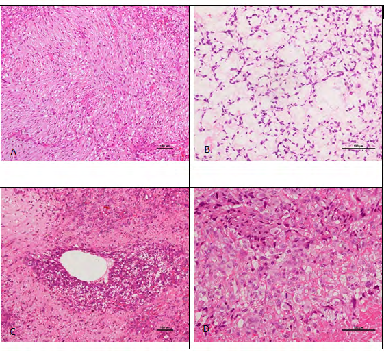 Figure 1: Histological feature of pulmonary artery intimal sarcoma. (A) Atypical spindle cells are arranged into the storiform pattern. (B) Mildly atypical spindle cells are embedded in the large myxoid areas, (C) The tumor cells show perivascular growth pattern. (D) The tumor cells demonstrated epitheloid appearance with conspicuous cytoplasm and enlarged nuclei. Hematoxylin–eosin staining, original magnification A, C × 100 and B, D × 200.