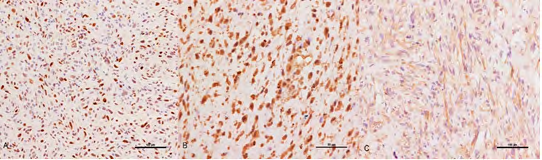 Figure 3: Immunohistochemical and FISH of MDM2 in pulmonary artery IS (A) Positivity expression of MDM2 in cell nuclei; (B) the presence of a large copy number of MDM2 gene organized in small clusters. Original magnification (A×200, B×400).