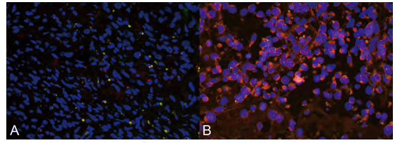 Figure 4: FISH analysis in pulmonary artery IS: the presence of a large copy number of MDM2 gene organized in small clusters (Original magnification ×400).