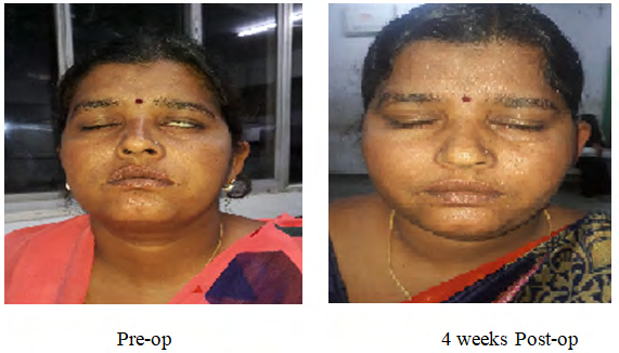 Figure 3: 1: Intra-operatively lesion was at 1st genu.
