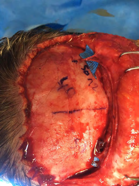 Figure 1: Aberrant sensory forehead nerves above normal supraorbital and supratrochlear nerves 12 mm above orbital rim and 40 mm lateral to midline bilaterally.