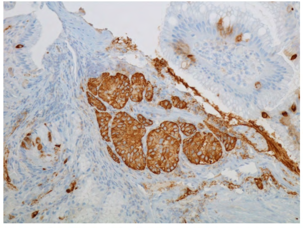 Figure 5: Chromogranin a magnification 200. Neuroendocrine cells positive for chromogranin A.