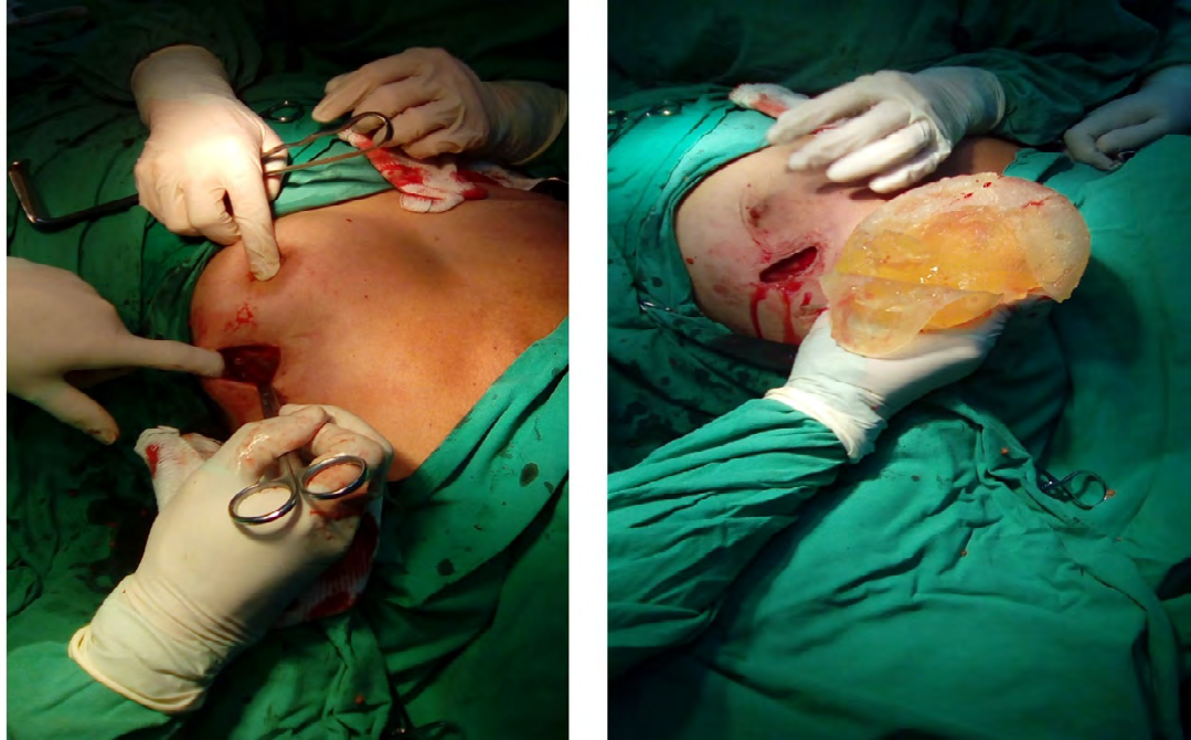 Figure 4: Intraoperative findings. A: Arc-shaped incision in the super external quadrant of the left breast through which oncological surgery was performed. B: Left breast prosthesis removed and with the broken silicone capsule on its anterior face.