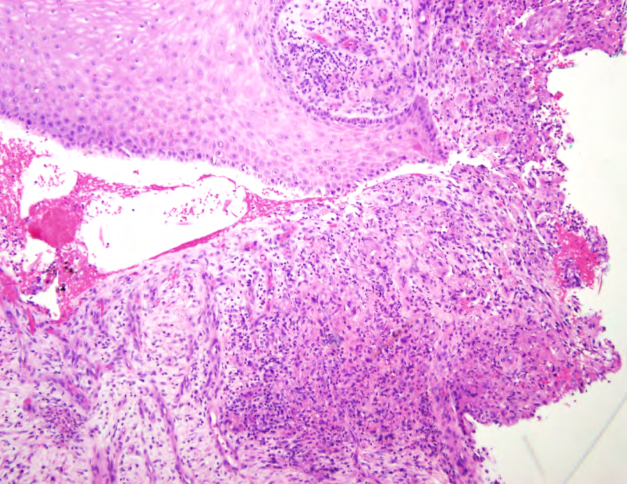 Figure 2: Histopathology of deep cutaneous Scedosporium infection. Skin biopsy demonstrates epidermal hyperplasia with suppurative and granulomatous inflammation and adjacent reparative dermal fibrosis (Hematoxylin and eosin stain, 100x).