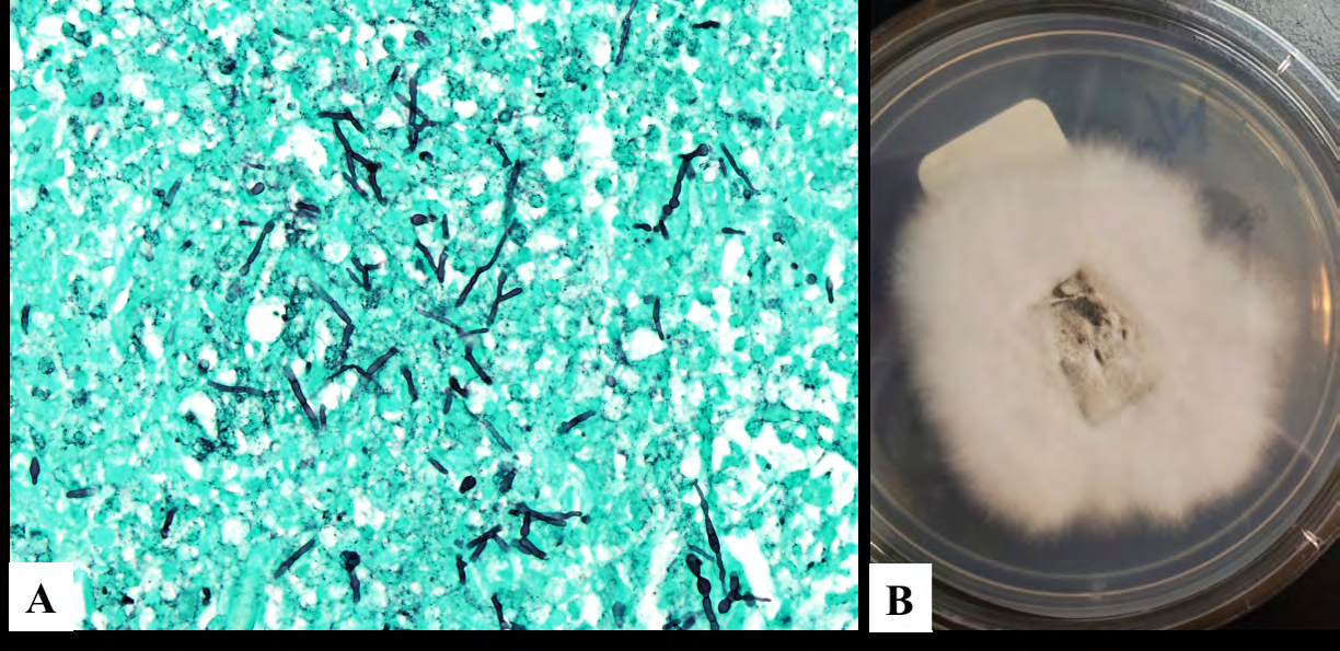 Figure 3: Fungal stain and fungal tissue culture of Scedosporium. (A) GMS stain shows numerous acute angle branching septate hyaline hyphal elements and yeast forms (GMS stain, 400x). (B) Plate growth of Scedosporium showing white rabbit-fur-like appearance that evolves into a house mouse gray like color in the center of the growth.