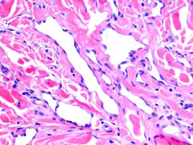 Figure 1: Benign lymphangioendothelioma demonstrating irregular, dilated lymphatic channels layered with “hobnail” endothelium and a circumscribing collagenous stroma [9].