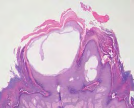 Figure 3: Benign lymphangioendothelioma exhibiting irregular lymphatic channels lined with plump endothelium, enveloping collagenous stroma and a superimposed hyperkeratotic, acanthotic stratified squamous epithelium [11].