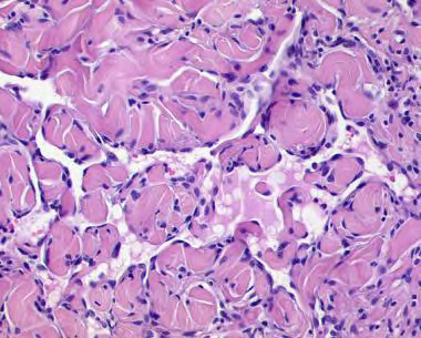 Figure 5: Benign lymphangioendothelioma enunciating irregular lymphatic spaces layered with “hobnail” endothelium and an encompassing fibro-collagenous stroma [13].