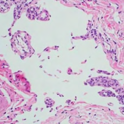 Figure 6: Benign lymphangioendothelioma exemplifying enlarged, irregular lymphatic spaces layered with plump endothelium enmeshed within a collagen-rich stroma [14].