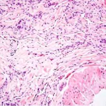 Figure 7: Benign lymphangioendothelioma exhibiting irregular lymphatic spaces coated with plump endothelial cells and a circumscribing collagenous stroma [15].