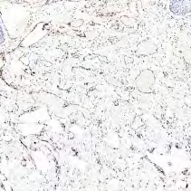Figure 8: Benign lymphangioendothelioma demonstrating immune reactive CD31 [15].