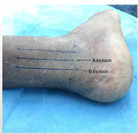 Figure 1: The tip of the lateral malleolus was set as a starting point at the same level outside the Achilles tendon as the endpoint to its trisection, two points were identified near the side of the Achilles tendon, and two vertical horizontal lines were drawn to represent incisions A and B.