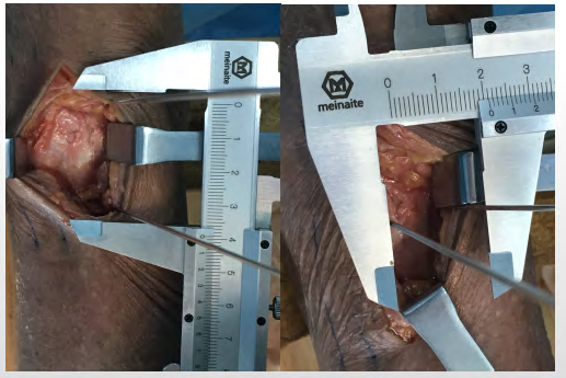 Figure 4: Measurement of length and width of exposed bone block.