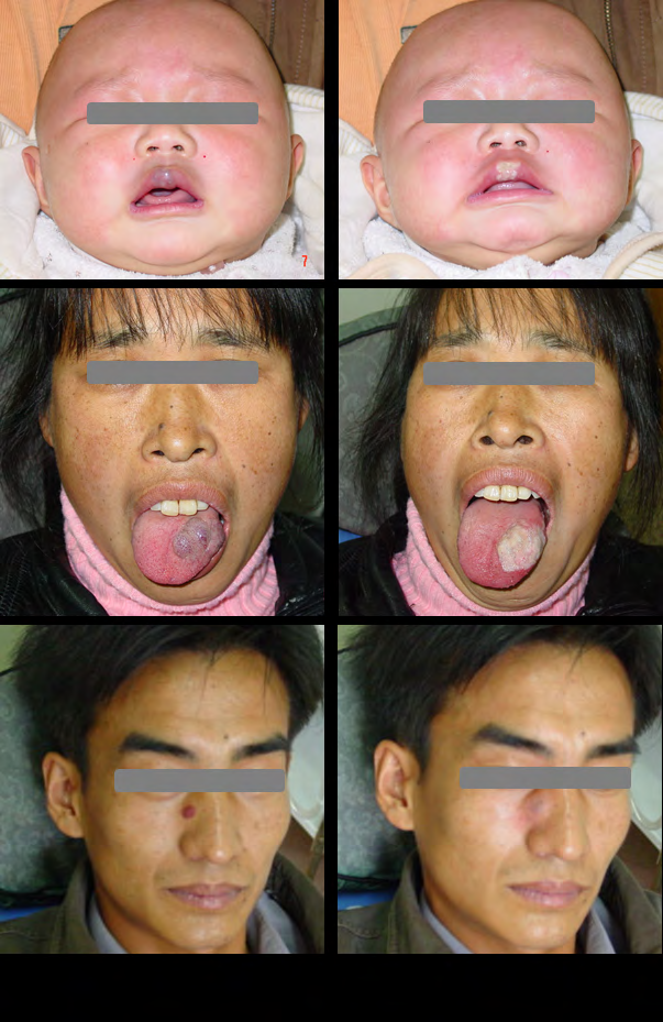 Figure 2: Pre- and post-Nd:YAG laser treatment for patients with venous malformations.