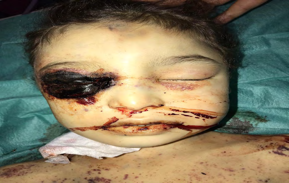 Figure 2: Periorbital lesion ulceronecrotic.
