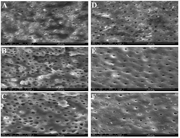 Figure 1: Scanning electron microscope photomicrographs (x4000 magnification). 0.3% Chitosan solution- irrigated group: (A) Coronal third. (B) Middle third. (C) Apical third. 20% citric acid solution-irrigated group: (D) Coronal third. (E) Middle third. (F) Apical third.