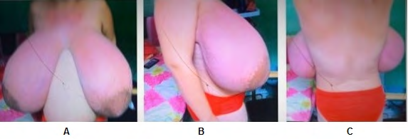 Figure 1: Pregnant women of 34.1 weeks. A: Front view, B: Side view; C: Back view. Consequently, she presented dissatisfaction with the appearance of her breasts, associated with postural pain and the inability to perform routine activities, including walking.