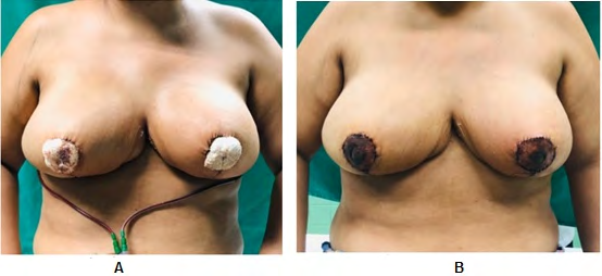 Figure 4: Postoperative period. A: Immediate postoperative. B: Postoperative after 7days.