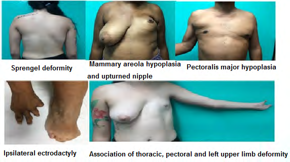 Figure 1: Anomalies associated with Poland sundrome.