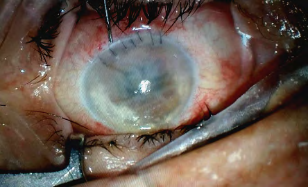 Figure 1: A severely injected conjunctiva, an edematous cornea with Descemet’s membrane folds with abundant keratic precipitates, anterior chamber hazy with cells and flare, and approximately 3.0 mm height hypopyon are observed.