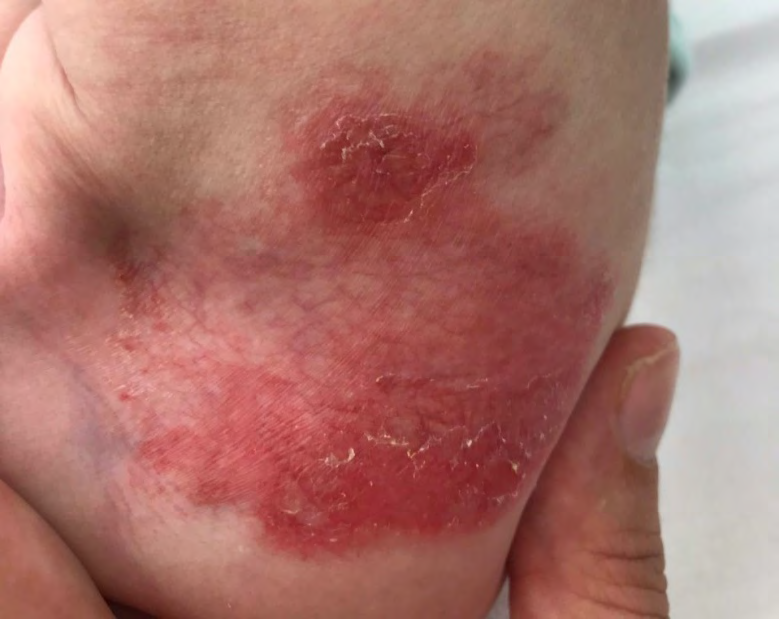 Figure 1: Atrophic patch of skin in the left inguinal region underlying the nappy, prior to treatment.