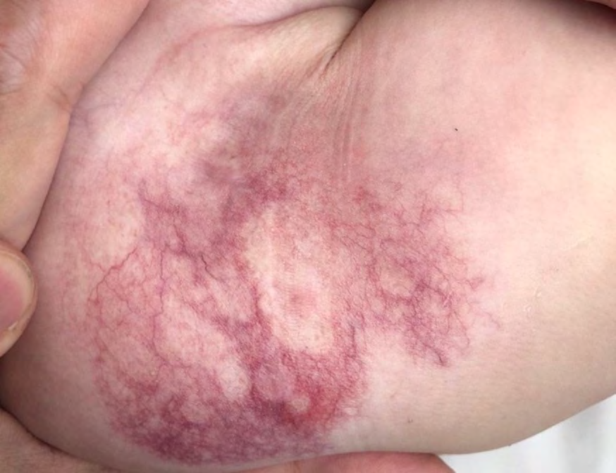 Figure 2: Skin in the left inguinal region underlying the nappy, months post treatment, showing good resolution of the eroded areas and dermatitis.