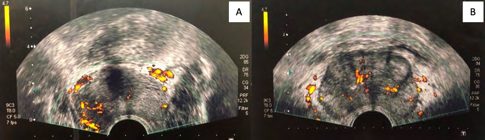 Figure 1: Representative images of doppler ultrasound findings. (A) Hyper vascularized area in peripheral prostatic zone. (B) Area with normal vascularization in peripheral prostatic zone.