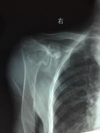 Figure 1: The X-ray films showed：the head of the humerus was applanation and hardened with osteophyte， the lower part of the glenoid cartilage disappeared, and the joint space narrowed down.