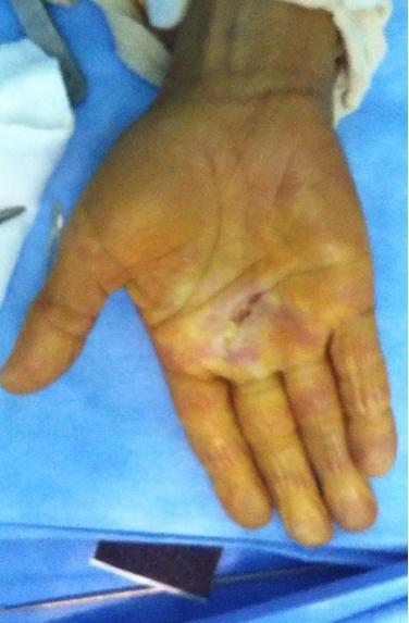 Figure 1: Photo illustrating the cutaneous approach. After dissection, the proximal pulley and the flexor tendons were exposed. On the thumb, the marking of the collateral pedicles was carried out first-line before the pulley and the flexor tendon were exposed.