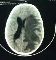 Figure 1: Preoperative Brain CT.