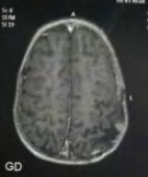 Figure 2: Post operatives brain MRI at 03 months postoperatively, in T1 sequence with gadolinium.