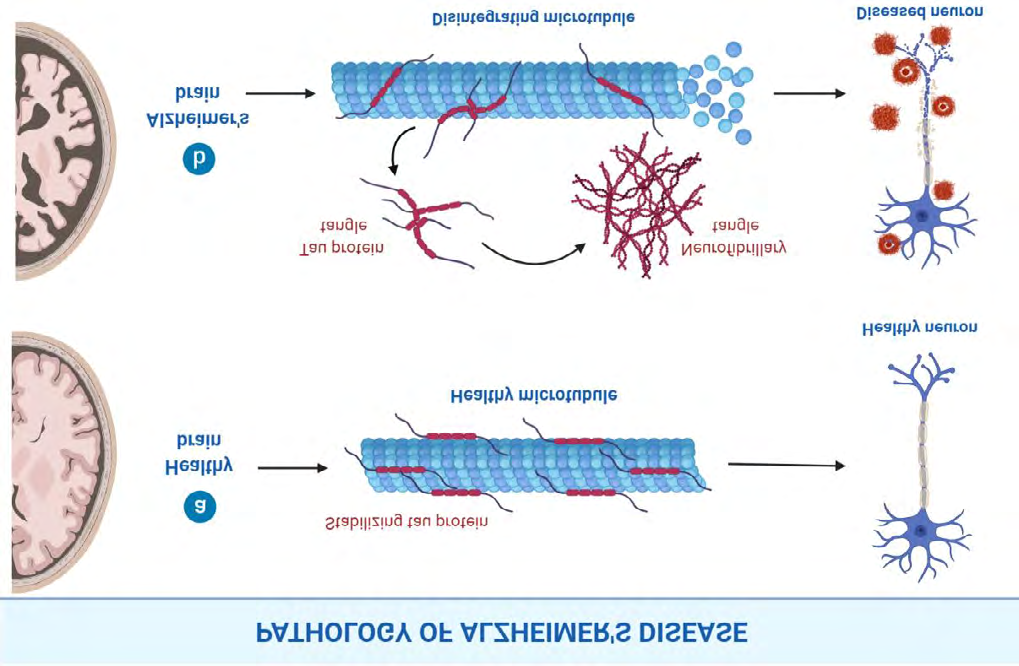 Figure 2: Role of tau hyperphosphorylation information of hyperphosphorylated neurofibrillary tangles [NFTs], which consequently leads to neurodegeneration and commencement of tauopathies.