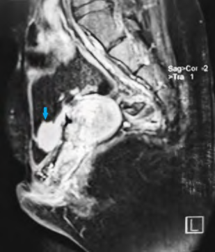 Figure 3: MRI showing a large bladder calculi (27x15 mm).