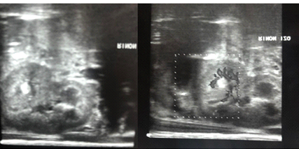 Figure 3: Left kidney measuring 4.5x2.6x2.8cm, upper pole with the presence of a hypoechogenic nodule that contacts the 4mm diameter renal medulla suggestive of fungoma.