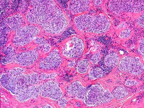 Figure 4: Plexiform fibrohistiocytic tumour exhibiting nodules of histiocyte-like cells, multinucleated giant cells, fibroblastic and fibro-histiocytic cells circumscribed with collagenous stroma [11].