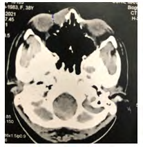 Figure 2: Anteriorly focal infiltration of skin was noted.