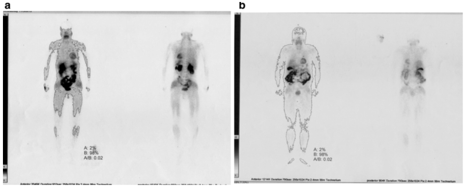 Figure 1: Entirety body radioisotope images patients were done the rest step after the 555-740 MBq (15-20 mCi) 99mTc-MIBI intravenously handled. Applying accessible commercial software, the accumulation proportion of radiotracer in the patient’s heart to complete body was calculated by isolating the action of heart to add up to body counts. 99mTc-MIBI uptakes within the heart to the whole body were roughly 2%. The 99mTc-MIBI complex tests were given here (a) ultrasound irradiation, (b) boiled water bath conditions.