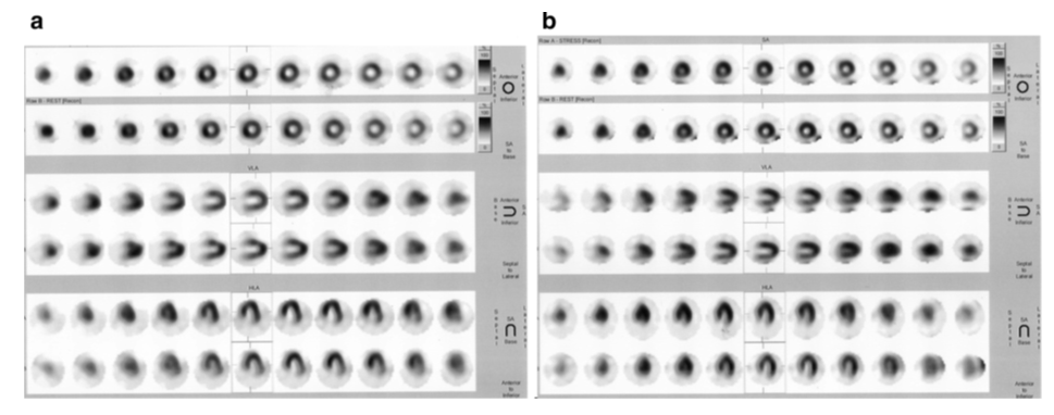 Figure 3: SPECT perfusion scans of the same patients were prepared with 99mTc-MIBI radiotracer tests. A 2-day stress/rest myocardial perfusion filtering convention was handled. The short-axis (beat 2 columns), vertical long-axis (center 2 lines) and even long-axis (foot 2 columns) cuts were revealed at push and rest. The images in to begin with push of brief pivot, vertical long pivot and flat long pivot have a place to the stretch stage of myocardial perfusion imaging. The camera rotation around the patient’s chest from 45°C right front angled (RAO) to 45°C cleared out back angled (LPO). The filters were given 1-2 h after the 555-740 MBq (15–20 mCi) 99mTc-sestamibi radiotracer tests organization intravenously, (a) radiopharmaceutical test arranged through sonication strategy, (b) 99mTc-MIBI complex test reconstituted by means of boiling water shower strategy.