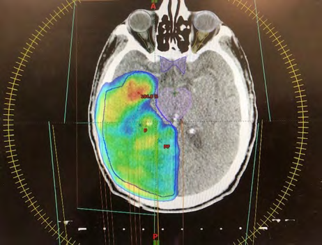 Figure 2: Isodose distribution of PTV with IMRT.