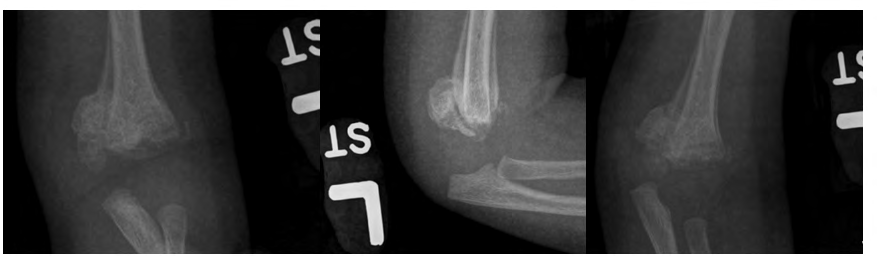 Figure 2: Anteriorposterior (AP), lateral and oblique radiographs confirm posterior transphyseal distal humeral separation with bony callus formation at 2 months.
