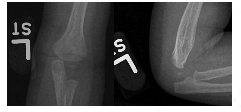 Figure 4: Anteriorposterior (AP) and lateral views reveal healed and remodeled left transphyseal distal humerus fracture, with posterior bowing.