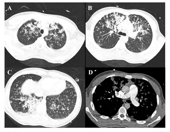 Figure 2: Patient 1. A), B), C): parenchymal opacities. D): increase of pulmonary artery caliber.