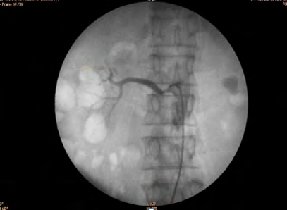 Figure 1: Renal angiography showing 80% stenosis right renal artery.