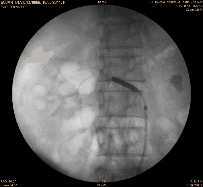 Figure 2: Right renal artery being stented.