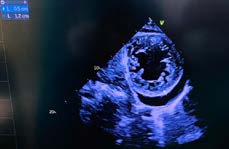 Figure 3: The ratio between noncompacted (1.2cm) and compacted wall (0.5cm) was more than 2 in the diastole.