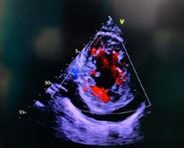 Figure 4: Cardiac magnetic resonance imaging of a case of left ventricular noncompaction. The thickness of non- compacted myocardium (18.18mm) is greater than 2.3 times the thickness of compacted myocardium (4.96mm).