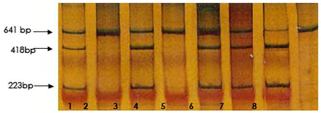 Figure 1: Silver stained PAGE of the Pdml (Xmn I)-digested PCR products. The 641-bp represents the uncut(-) site, while the 418-bp and 223-bp fragments represent the cut (+) site. Samples 1,3,5 and 6 are -/+, whereas sample 7 is +/+, and 2,4 and 8 are -/-.