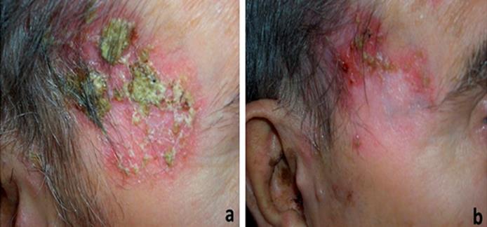 Figure 2: Patient 2. a. Pre-treatment. b. Day 60: Squamous cell carcinoma located on the right hairline/scalp.