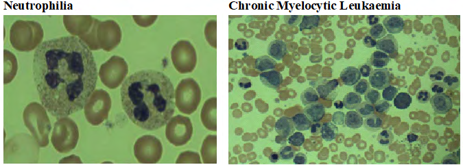 Figure 6: Blood Picture showing Neutrophilia and Chronic Myeloid Leukaemia.