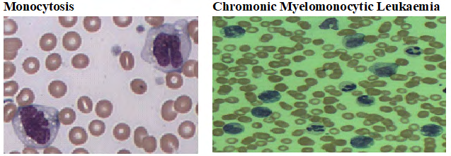 Figure 8: Picture showing monocytosis and chronic Myelomonocytic leukaemia.